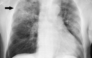 هشدار درباره یک بیماری حاد تنفسی در سرما